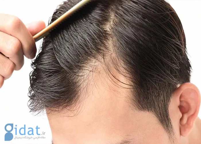 دلایل ریزش مو راهکارهای درمانی